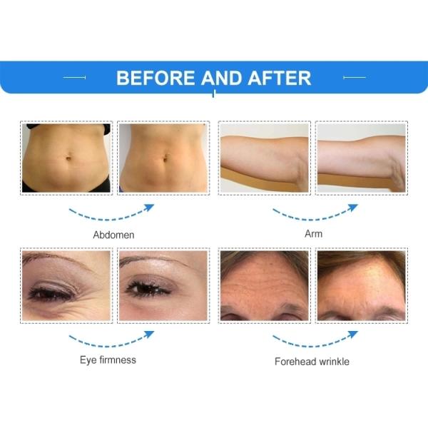 High Quality Rotating Eliminate Fat Quantum Rf Vacuum Pdt Weight Loss Machine Lf-109