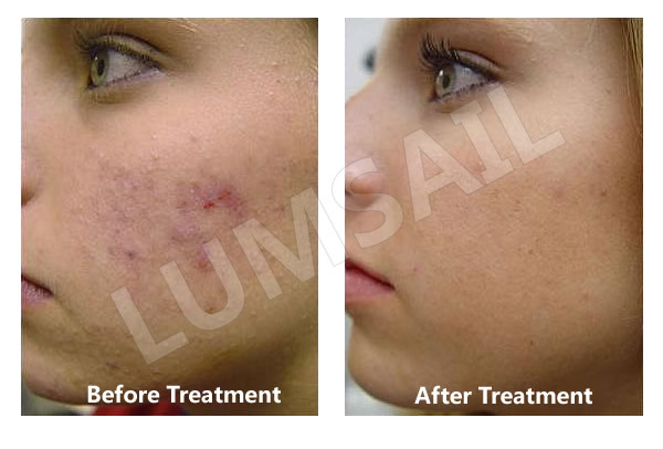 4 ColorLED Phototherapy Machine For Decrease Spider Veins / Broken Capillaries