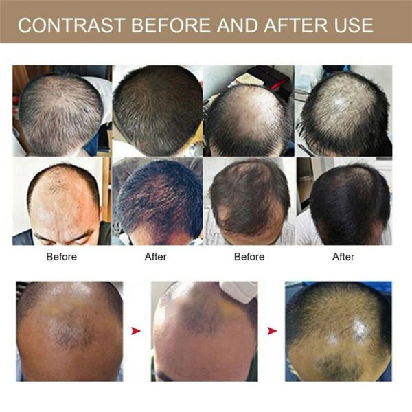 650nm Led Light 30 Diode 26 Lasers Hair Growth Helmet Laser Therapy For Hair Loss