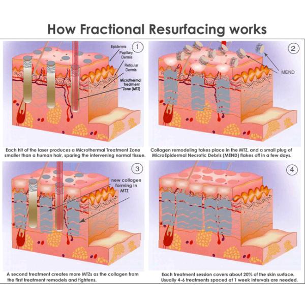 Tightening Skin Fractional CO2 Laser Beauty Machine For Acne Pigment Scar Removal
