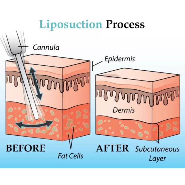 Slimming Body Reshaping Vacuum Suction Machine Face Lifting Beauty Machine