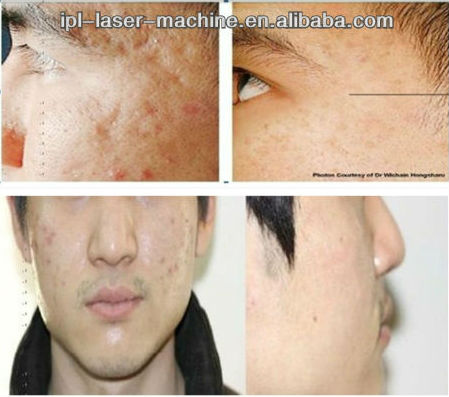 2018 high performance nubway secret fractional rf for skin lifting skin tightening with cheap price