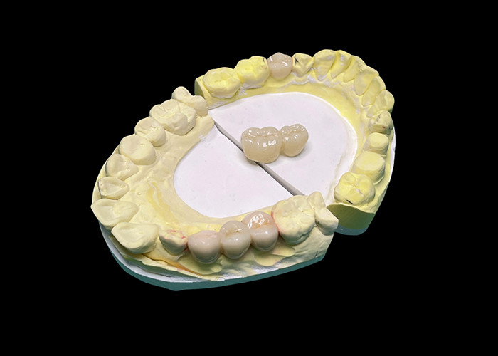 Advanced Translucency Ceramic Crowns and Bridges Enhance Your Smile with