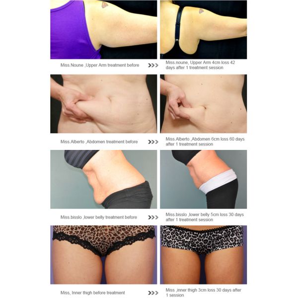 2016 professional fat reduce slimming equipment cryo fat freeze machine with 2 years warranty