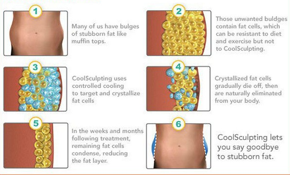 Europe popular 4 handpieces Cryomed Cryolipolysis RF Cool Shaping Slimming Machine