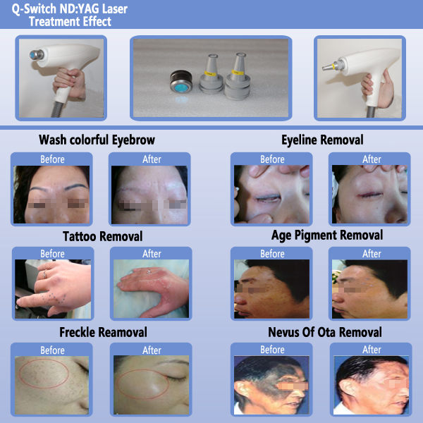 Yag Verticle E-light IPL RF For Tattoo Removal / Hair Removal