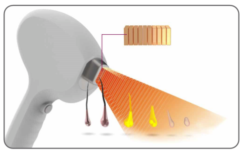 Newest China beauty equipment 808nm diode laser FMD-11 diode laser hair removal machine for sale