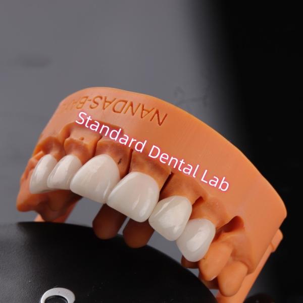 Comfort and Function with Digital CAD CAM Dental Lab Translucent Layered Zirconia Bridge