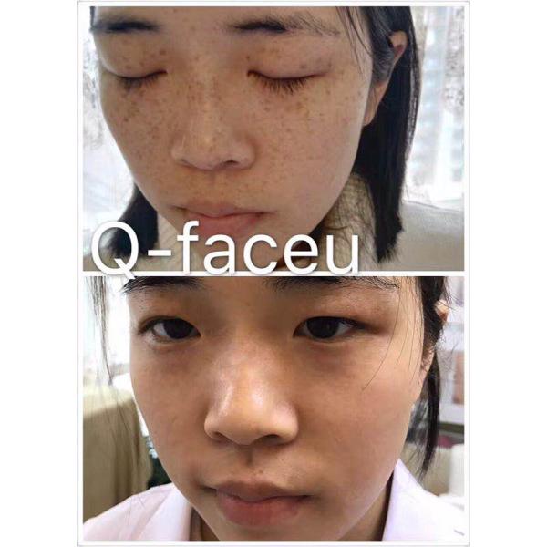 width pulse 600ps anti-wrinkle skin rejuvenation tattoo removal picosure in spa clinic