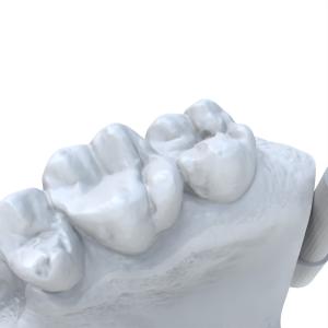 Precision Dental Model Resin Ultra Tough Dental Resin 3d Printing