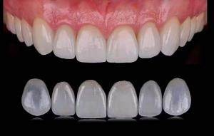 China Tranlucent Emax Laminate Veneers / Porcelain Dental Veneers ISO Approved on sale