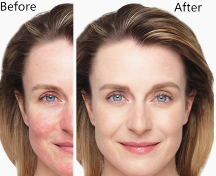 Air Cooling 980 Nm Diode Laser Vascular Removal Machine , Red Spider Vein Removal Machine