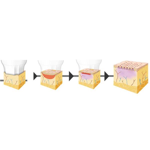 Fractional Radiofrequency Micro Needling Wrinkle Removal