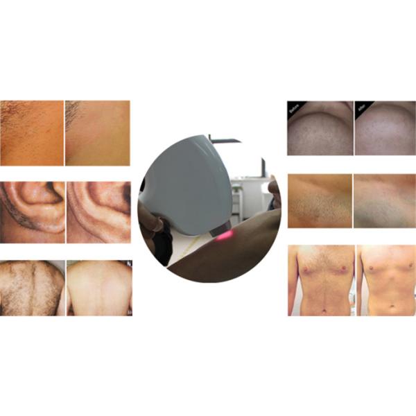 diode laser hair removal machine 808nm laser diode hair remover machine