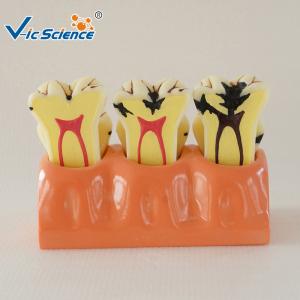 China Decayed Tooth Orthodontic Study Models 4 Times Caries Disassembling Model on sale
