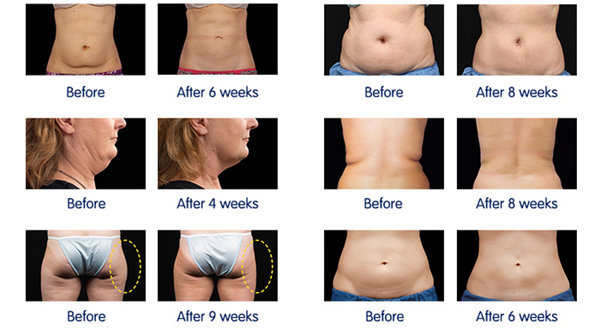 September Promotion Safe Cryolipolysis Slimming Machine 10.4 Inch For Fat Reduction