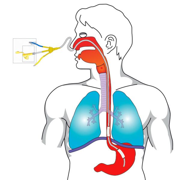 Enteral Feeding Tube With One / Two Balloons For Esophageal Pressure Measurement