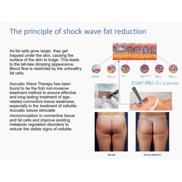 3D Acoustic Shockwave Therapy Equipment Ultrasonic Fat Loss Equipment