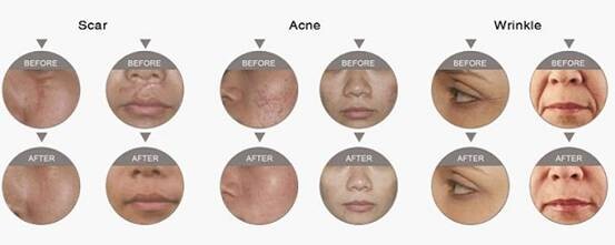 220V Fractional laser skin treatment machine remove acne scar 1550nm