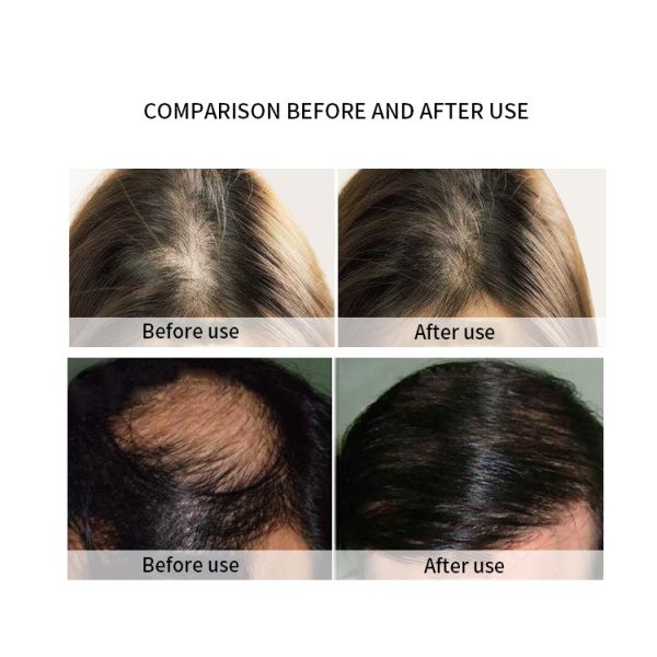 Personal Power Hair Grow Laser Brush Electric Comb for Hair Loss Treatment