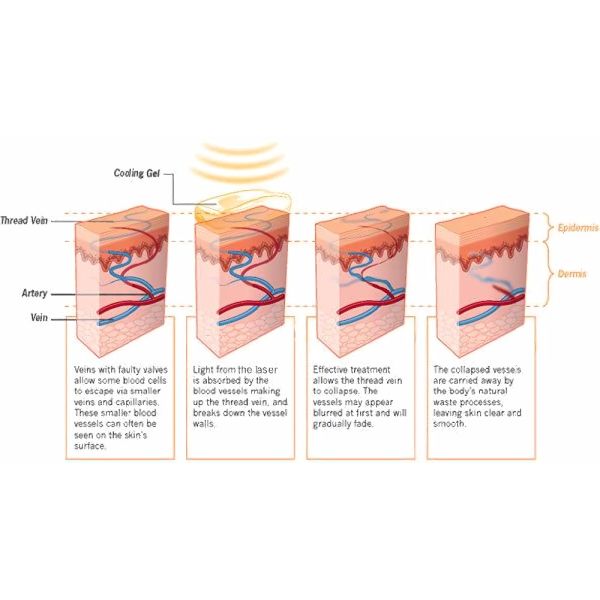 Skin Rejuvenation Spider Vein Treatment Machine , Adjustable Laser Vein Removal Machine