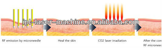 2018 high performance nubway secret fractional rf for skin lifting skin tightening with cheap price