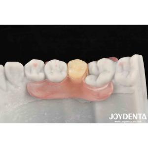 Flexible Denture Finish Personalized Customization and Advanced Tooth Arrangemen