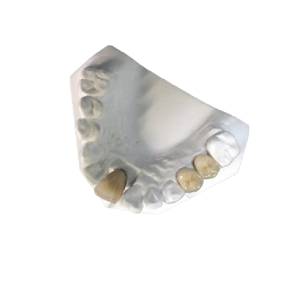 Yellow Gold Porcelain Dental Crown Lab High Strength PFM Ceramic Crown