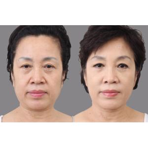 China Beauty &amp; Personal Care HIFU FACE hifu focused ultrasound beauty treatment for instant face lifting wholesale