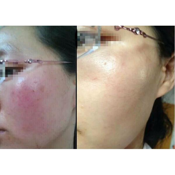 Skin Rejuvenation Spider Vein Treatment Machine , Adjustable Laser Vein Removal Machine