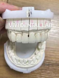 China High Esthetics Zirconia Dental Lab Crowns Bridge With Layered Porcelain wholesale