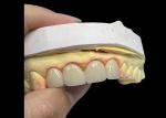 Advanced Translucency Ceramic Crowns and Bridges Enhance Your Smile with