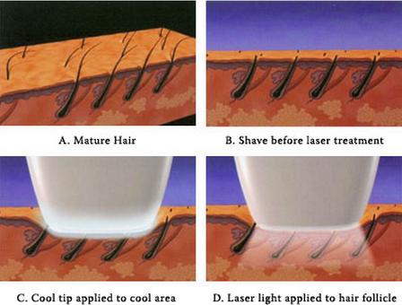 High Quality of Portable 808nm Diode Laser Hair Removal Machine Beauty Spa Hair Removal