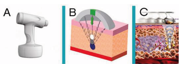 500w big power 12mm ultrasound focused liposuction abdomen of removal