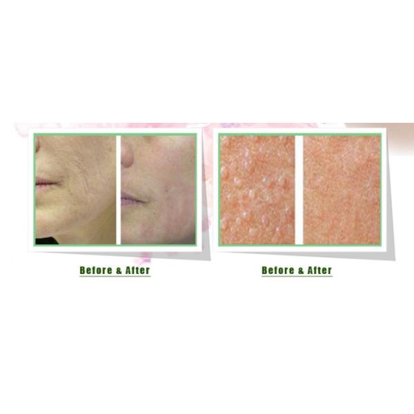 1550nm Diode Erbium Laser Machine Glass Fractional Laser Skin Resurfacing Equipment