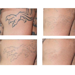 600ps Picosecond device tatoo pigment removal acne scars removal machine price