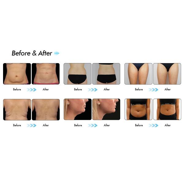 cryolipolysis body slimming machine