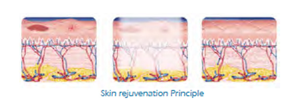 Nubway Factory promotion price hot selling professioal shr ipl hair removal machine hand piece shr ipl with FDA CE