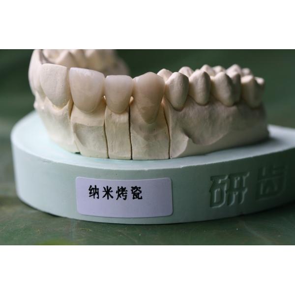 3D Print Framework PFM Dental Lab Crown For Dentistry