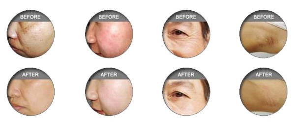 SHR best professional ipl machine for hair removal Pain free equipment for beauty salon