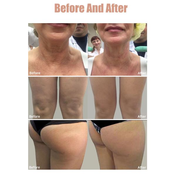 Multi-functional MFU RF HIFU Machine for Face and Body Skin Tightening and Lifting with 4 Handles and 10 Cartridges