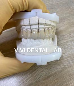 China Precise Dental Lab Crowns Esthetic Porcelain Zirconia Tooth Crown wholesale