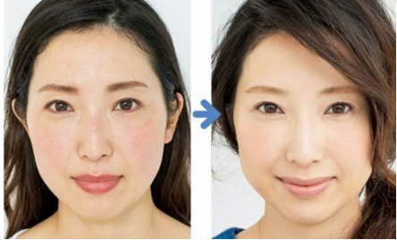 Air Cooling 980 Nm Diode Laser Vascular Removal Machine , Red Spider Vein Removal Machine