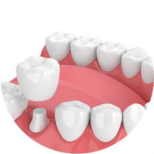China Beautiful Dental Crowns And Bridges Smooth Surface For Oral Hygiene Safety wholesale
