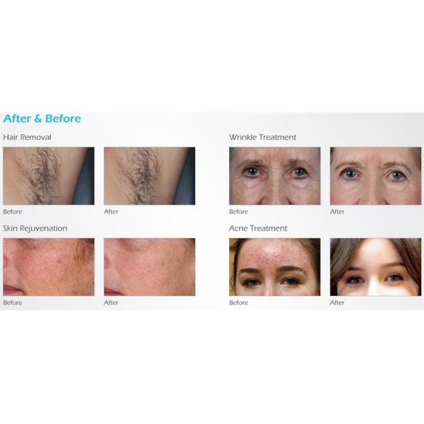 Top beauty clinic use stand 3000W multifuntion best shr ipl machine hair removal