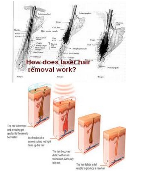diode laser hair removal machine 808nm laser diode hair remover machine