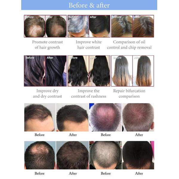 Q Switch 6pcs Pads LED PDT Machine Professional Hair Regrowth Machine