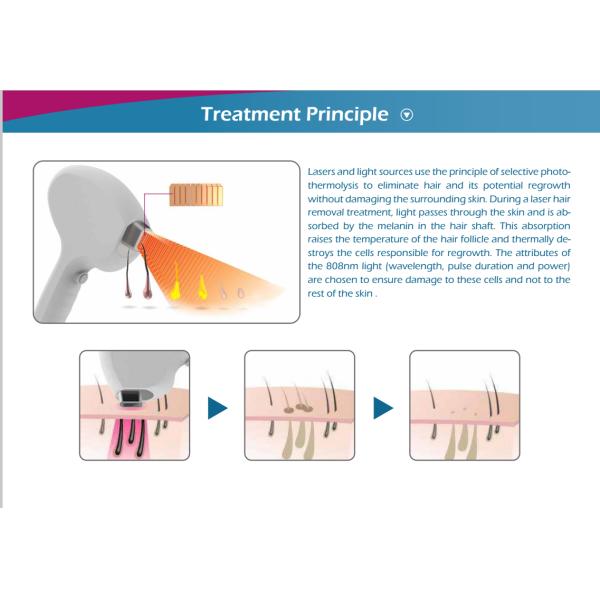 Intense laser pulse output,high performance on result,painless treatment,Portable Diode Laser Hair Removal Machine