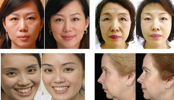 10Mhz Fractional RF Face Lift Acne Scar Removal 1000W