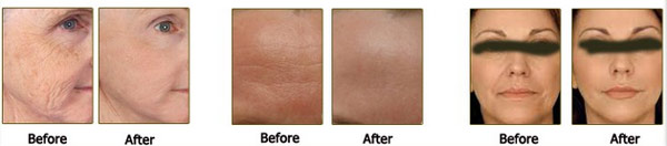 High Intensity Focused on Ultrasound machine with 4MHZ, 7MHZ, 10MHZ frequency